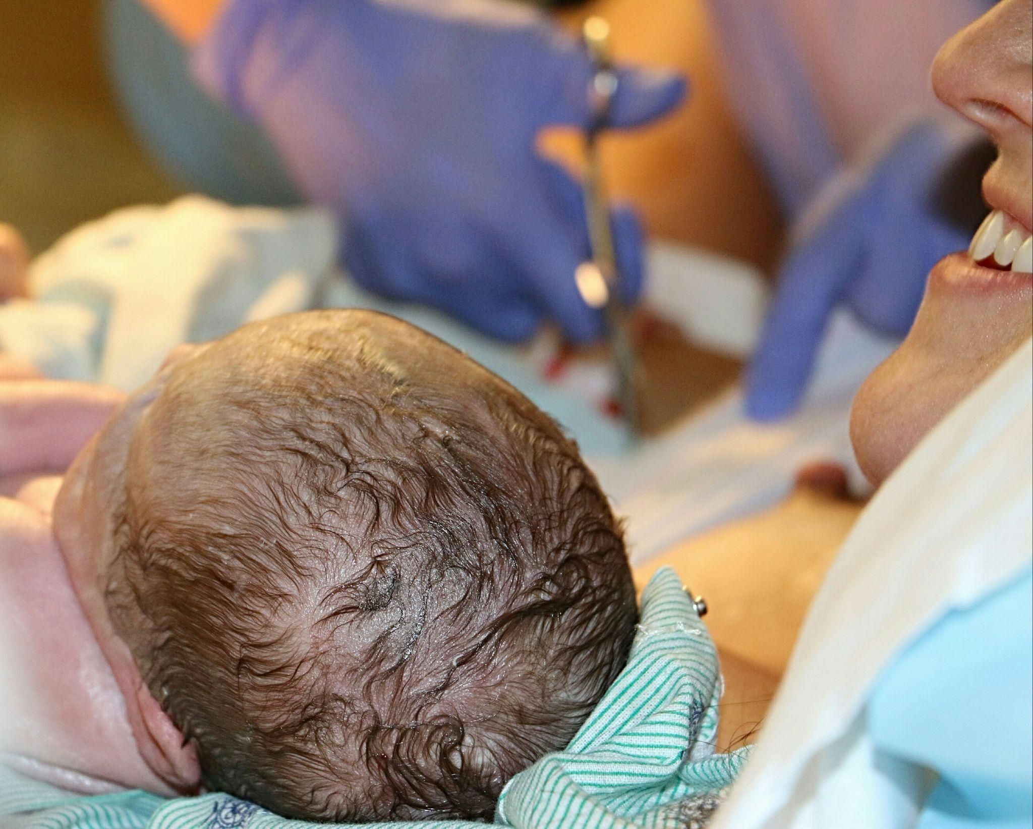 Midwife performed a Kiwi Cup delivery during assisted childbirth.