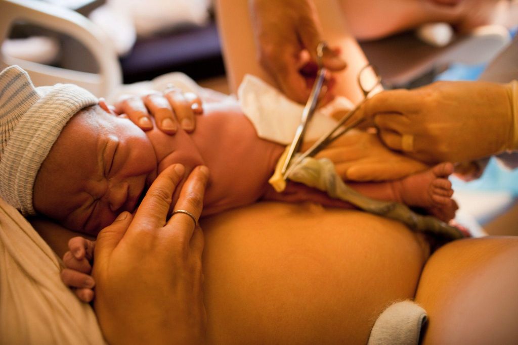 Baby having his umbilical cord cut.