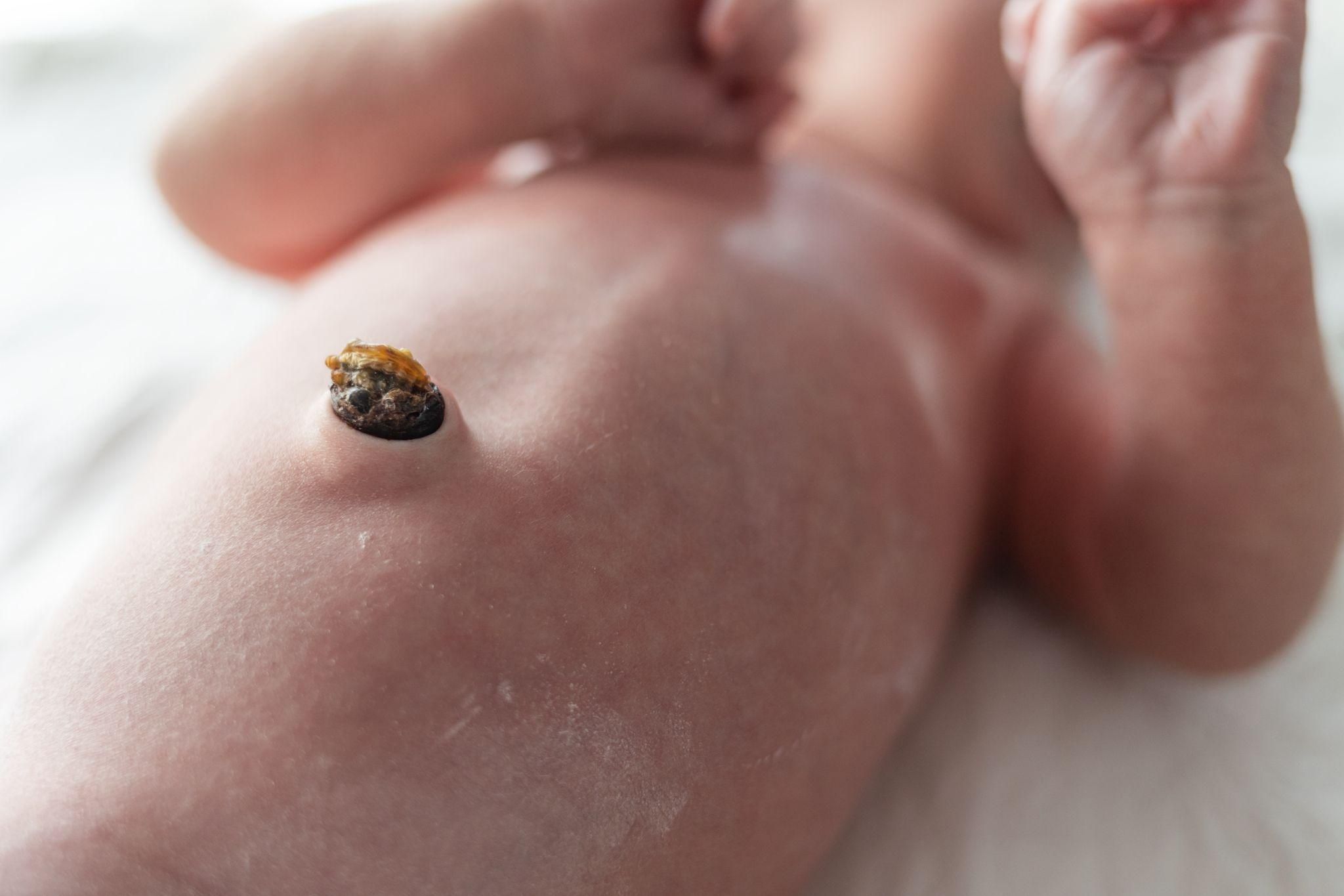 Close-up of a newborn’s belly button with a healing umbilical stump.