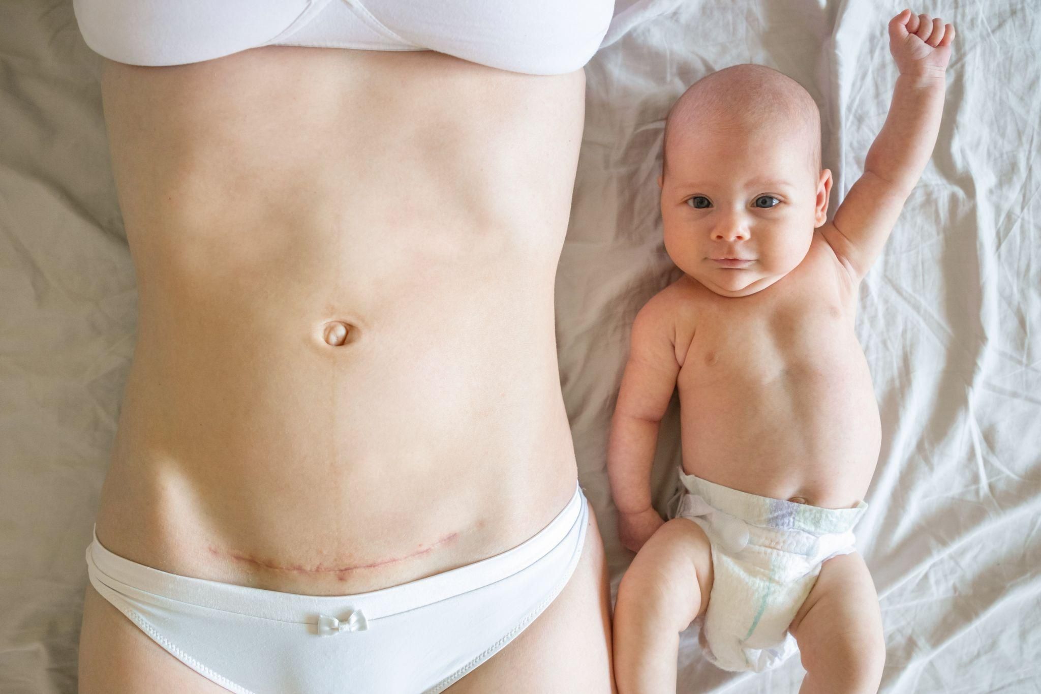 A new mother massaging her C-section scar with a healing cream.