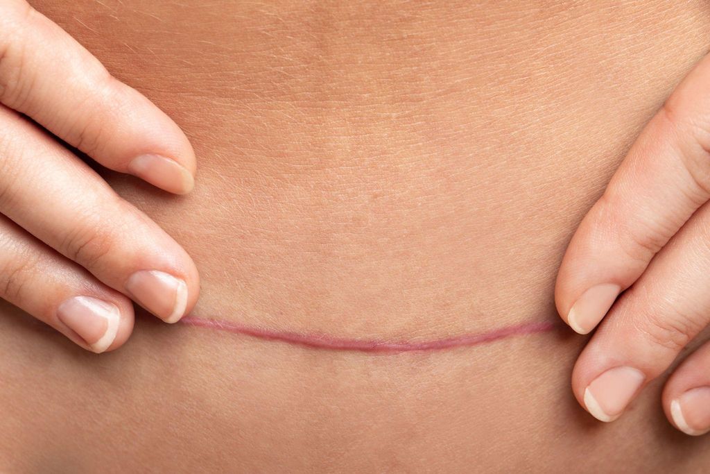 C-Section Scar Healing